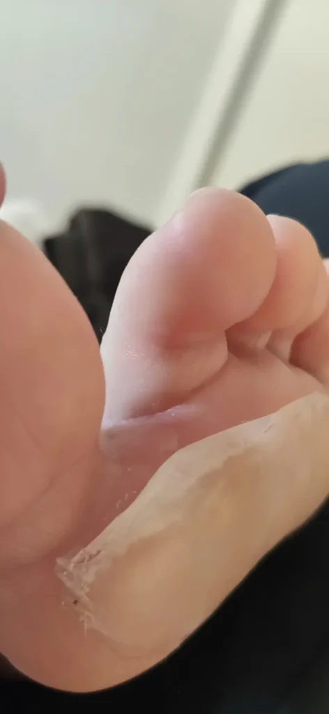 Detalle de una ampolla tratada con un apósito hidrocoloide, una de las soluciones más comunes en el Camino.