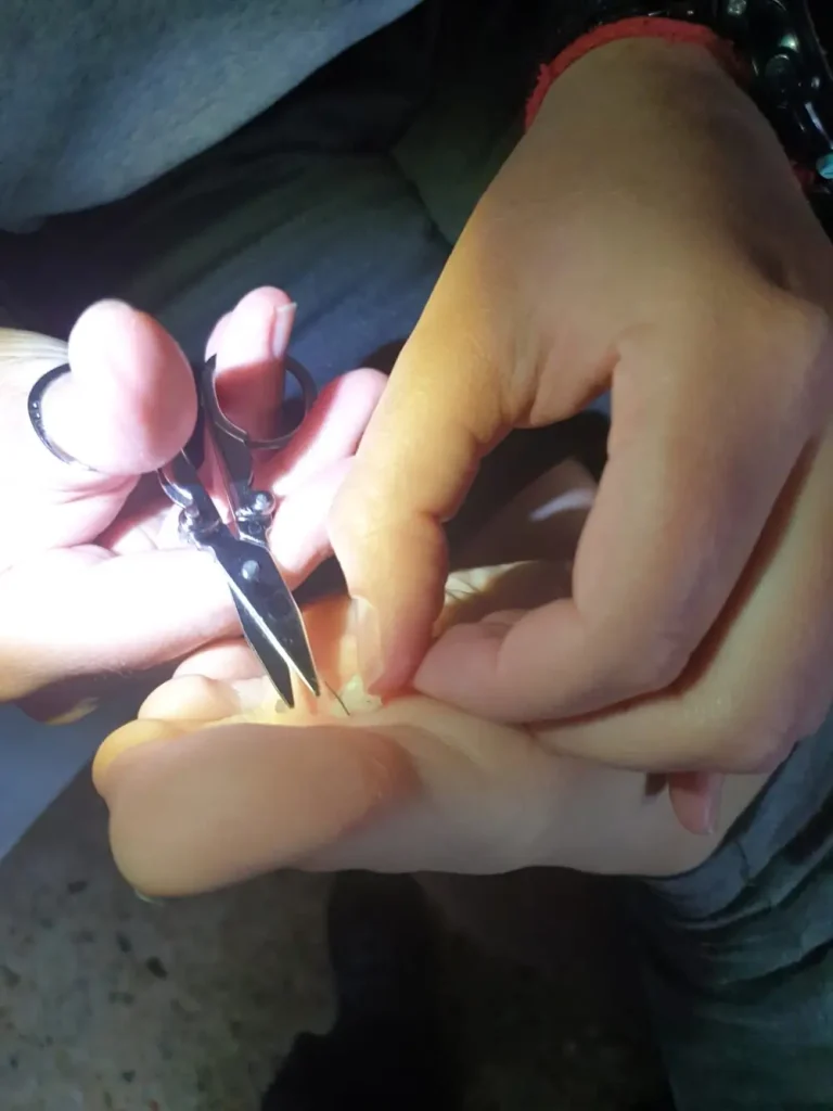Primer plano de un pie con un hilo atravesando una ampolla para facilitar su drenaje de forma higiénica y continua.